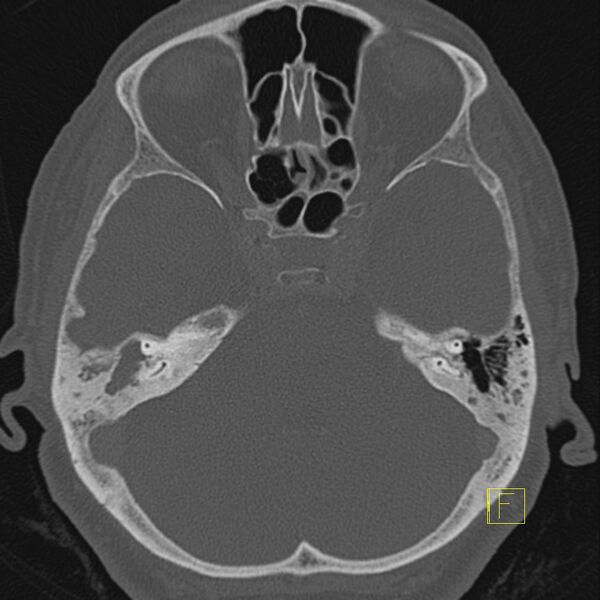 File:Cholesteatomatous chronic otitis (Radiopaedia 14993-14911 Axial bone window 4).JPEG