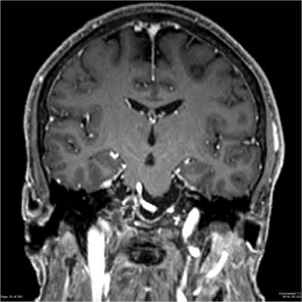 File:Chondrosarcoma of skull base- grade II (Radiopaedia 40948-43654 Coronal T1 C+ 2).jpg
