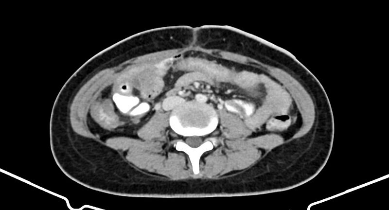 File:Choriocarcinoma liver metastases (Radiopaedia 74768-85766 A 124).jpg