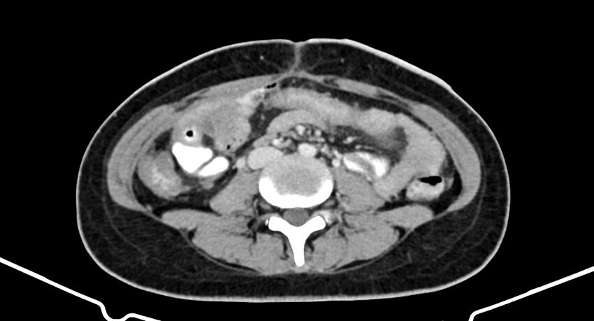 Choriocarcinoma liver metastases (Radiopaedia 74768-85766 A 124).jpg