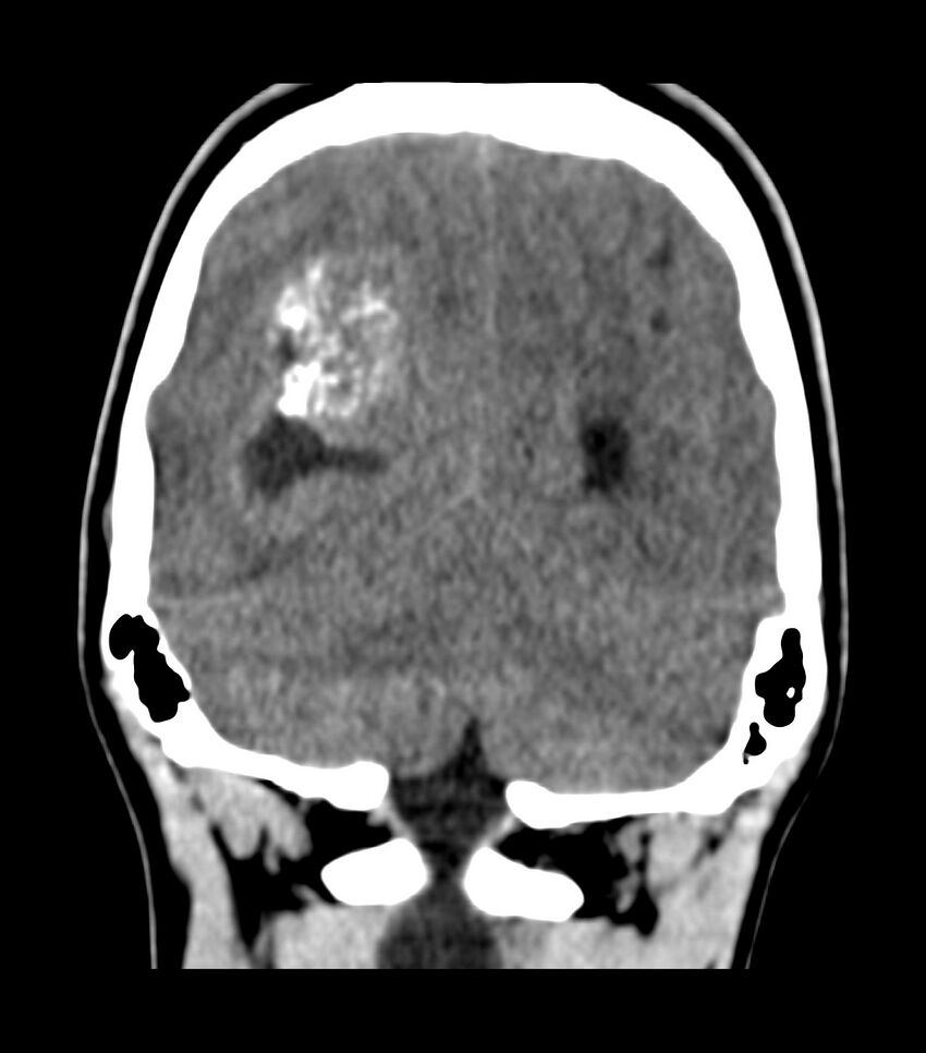 Choroid plexus carcinoma (Radiopaedia 91013-108552 Coronal non-contrast 67).jpg