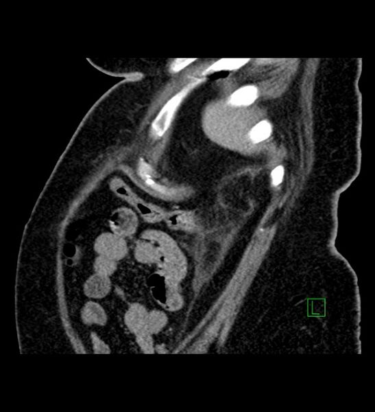 File:Chromophobe renal cell carcinoma (Radiopaedia 84239-99519 D 19).jpg
