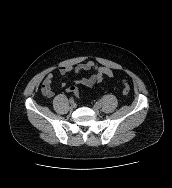 File:Chromophobe renal cell carcinoma (Radiopaedia 84337-99693 Axial non-contrast 115).jpg
