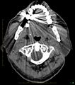 Chronic Submandibular sialolithiasis (Radiopaedia 16880-16606 Axial non-contrast 7).jpg