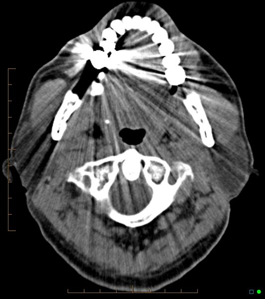 File:Chronic Submandibular sialolithiasis (Radiopaedia 16880-16606 Axial non-contrast 7).jpg