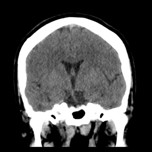 File:Chronic bilateral occipital lobe infarcts (Radiopaedia 31276-31996 Coronal non-contrast 24).jpg