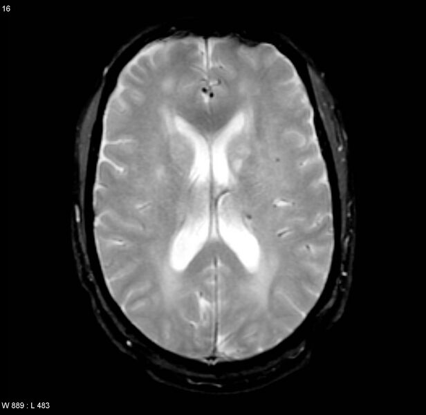 File:Chronic hypertensive encephalopathy (Radiopaedia 4564-6686 Axial Gradient Echo 11).jpg
