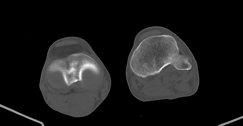 File:Chronic osteomyelitis (with sequestrum) (Radiopaedia 74813-85822 Axial non-contrast 197).jpg