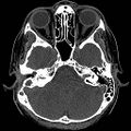 Chronic otomastoiditis (Radiopaedia 27138-27309 Axial non-contrast 28).jpg