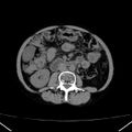 Chronic pancreatitis (Radiopaedia 23132-23172 Axial non-contrast 42).jpg