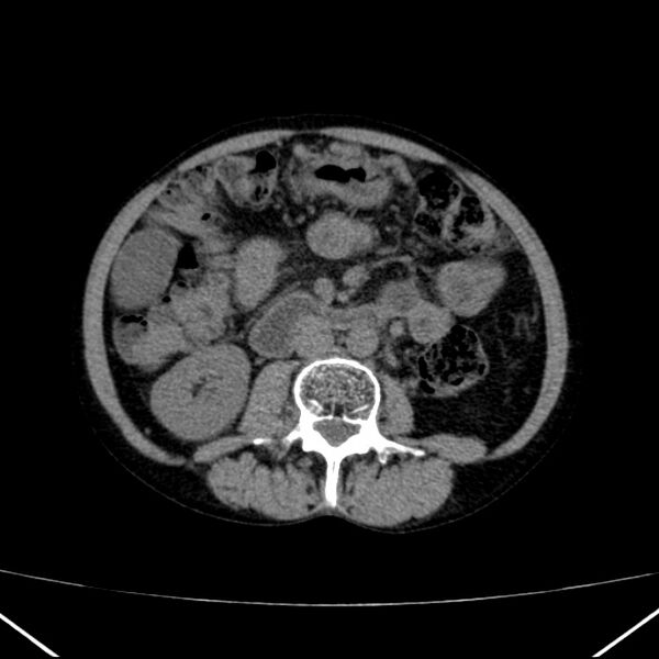 File:Chronic pancreatitis (Radiopaedia 23132-23172 Axial non-contrast 42).jpg