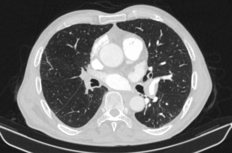 File:Chronic pulmonary embolism (Radiopaedia 91241-108843 Axial lung window 47).jpg