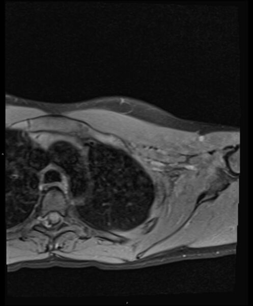 File:Chronic reactive multifocal osteomyelitis (CRMO) - clavicle (Radiopaedia 56406-63114 Axial T1 fat sat 17).jpg
