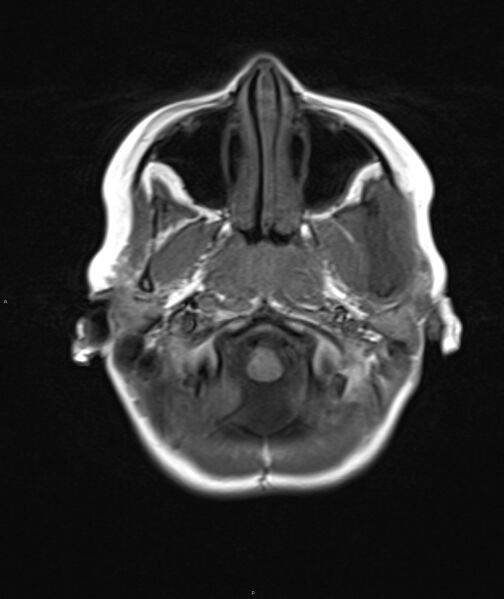 File:Chronic reactive multifocal osteomyelitis (CRMO) - mandible (Radiopaedia 56405-63069 Axial T1 19).jpg