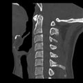 Clay-shoveler fracture (Radiopaedia 22568-22590 Sagittal bone window 20).jpg