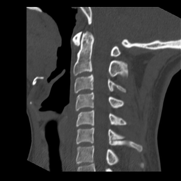 File:Clay-shoveler fracture (Radiopaedia 22568-22590 Sagittal bone window 20).jpg