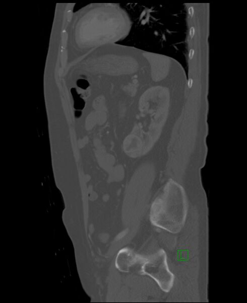 File:Clear cell renal cell carcinoma (Radiopaedia 85006-100539 Sagittal bone window 18).jpg