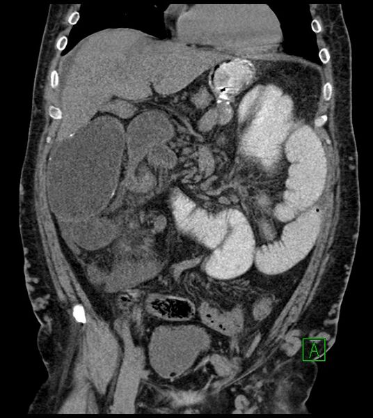 File:Closed-loop small bowel obstruction-internal hernia (Radiopaedia 78439-91096 Coronal non-contrast 41).jpg