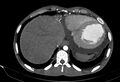Coarctation of aorta with aortic valve stenosis (Radiopaedia 70463-80574 A 199).jpg