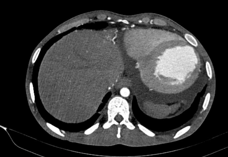 File:Coarctation of aorta with aortic valve stenosis (Radiopaedia 70463-80574 A 199).jpg