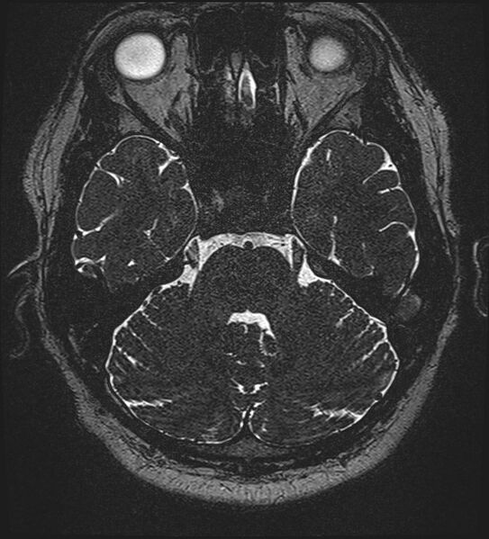 File:Cochlear incomplete partition type III associated with hypothalamic hamartoma (Radiopaedia 88756-105498 Axial T2 98).jpg