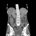 Colocolic fistula - Crohn disease (Radiopaedia 57063-63955 B 27).jpg