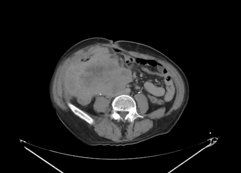 File:Colon cancer mimicking renal cell carcinoma (Radiopaedia 28986-29335 Axial C+ delayed 46).jpg