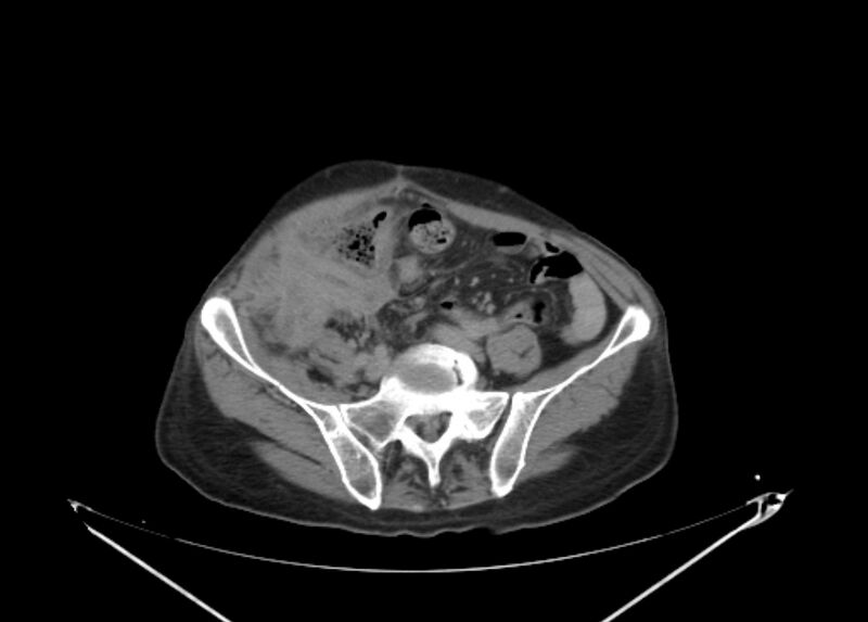 File:Colon cancer mimicking renal cell carcinoma (Radiopaedia 28986-29335 Axial C+ delayed 55).jpg