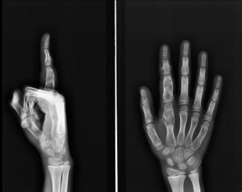 Multiple (enchondromatosis) in fingers