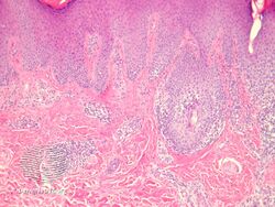 Inflammatory linear verrucous epidermal nevus-pathology