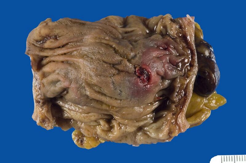 File:Fresh stab wound of the transverse colon (gross pathology) (Radiopaedia 29961).jpg
