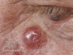 Merkel cell carcinoma (DermNet NZ lesions-mcc3).jpg