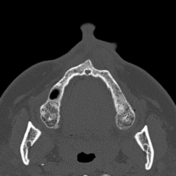 File:Nasolabial cyst (Radiopaedia 33987-35205 Axial bone window 3).jpg