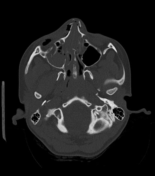 File:Nasoorbitoethmoid fracture (Radiopaedia 90044-107205 Axial bone window 69).jpg