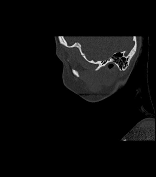File:Nasoorbitoethmoid fracture (Radiopaedia 90044-107205 Sagittal bone window 125).jpg