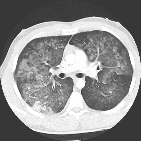 File:Near drowning pulmonary edema (Radiopaedia 16868-16591 Axial lung window 19).jpg