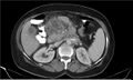Necrotizing pancreatitis (Radiopaedia 20595-20495 A 15).jpg