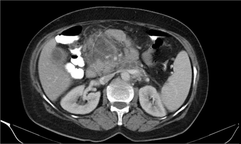 File:Necrotizing pancreatitis (Radiopaedia 20595-20495 A 15).jpg