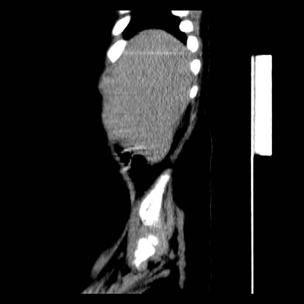 File:Neuroblastoma with skull metastases (Radiopaedia 30326-30960 B 5).jpg