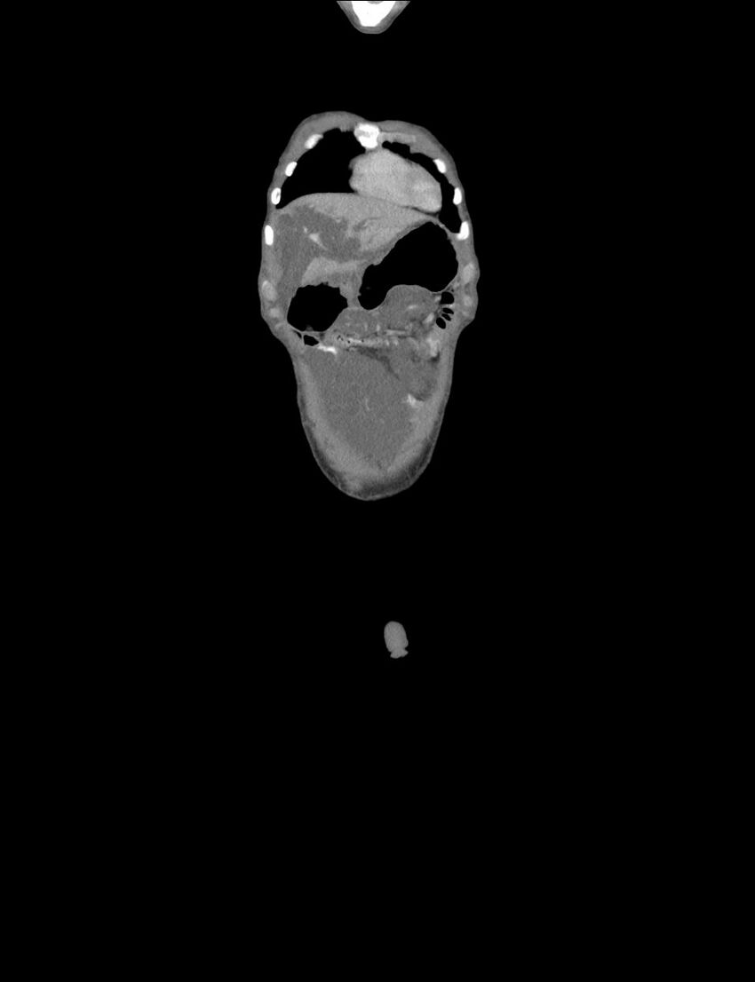 Neurofibromatosis type 1 (Radiopaedia 49538-54733 B 46).jpg