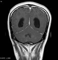 Neurofibromatosis type 2 - cranial and spinal involvement (Radiopaedia 5351-7111 Coronal T1 C+ 12).jpg