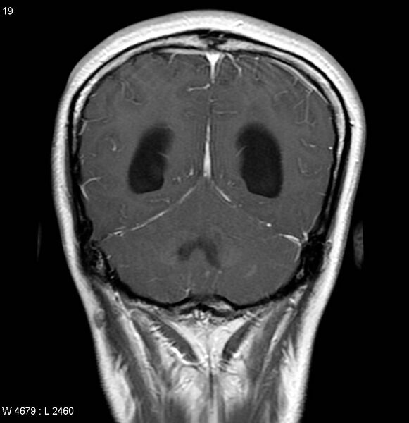 File:Neurofibromatosis type 2 - cranial and spinal involvement (Radiopaedia 5351-7111 Coronal T1 C+ 12).jpg
