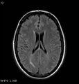 Neurosarcoidosis (Radiopaedia 10930-11351 Axial FLAIR 12).jpg