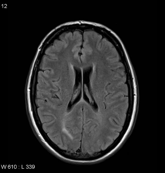 File:Neurosarcoidosis (Radiopaedia 10930-11351 Axial FLAIR 12).jpg