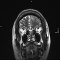 Neurotoxoplasmosis - concentric target sign (Radiopaedia 70644-80784 Coronal T2 37).jpg