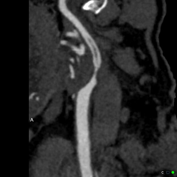 File:Non-occlusive intraluminal internal carotid artery thrombus (Radiopaedia 37751-39658 A 50).jpg
