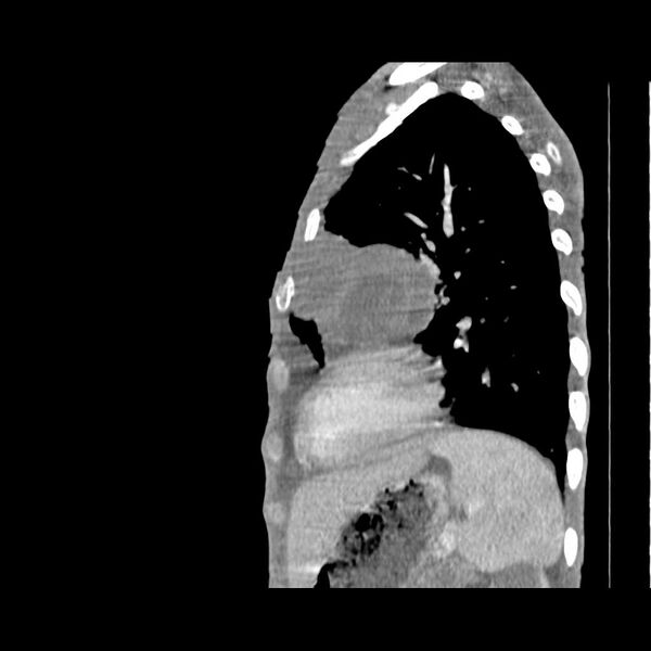 File:Non hodgkin lymphoma of the mediastinum (Radiopaedia 20814-20729 D 5).jpg