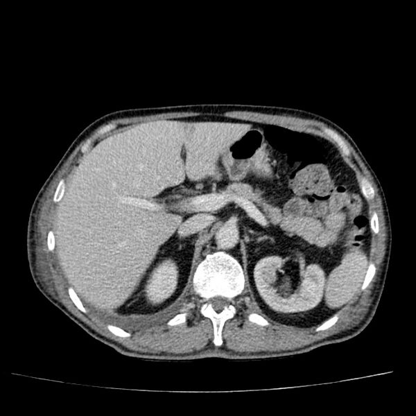 File:Non small-cell lung cancer (Radiopaedia 24467-24769 C+ delayed 63).jpg