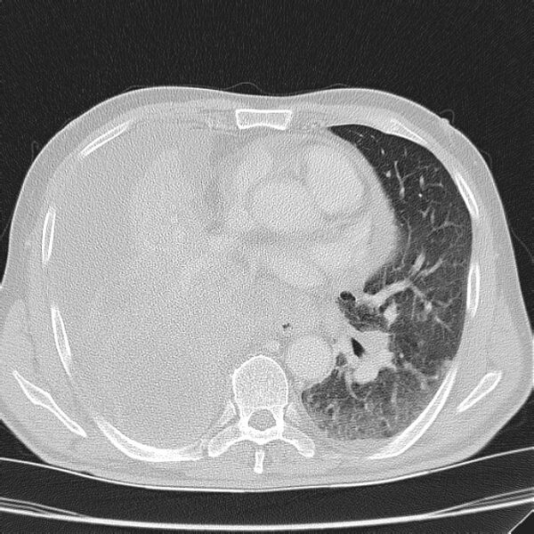 File:Non small-cell lung cancer (Radiopaedia 24467-24769 lung window 27).jpg