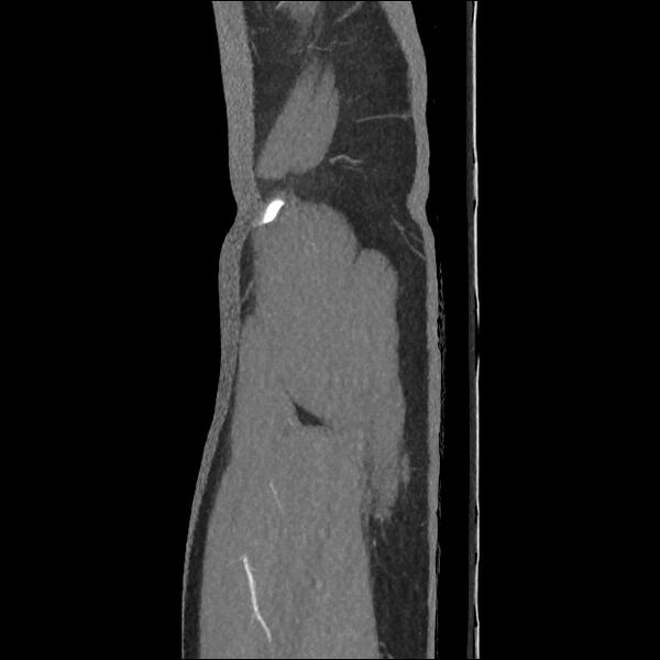 File:Normal CT angiogram of pelvis (Radiopaedia 45390-49430 C 6).jpg